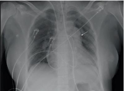 Case report: Extracorporeal life support as a successful bridge to recovery in an incident case of pulmonary arterial hypertension